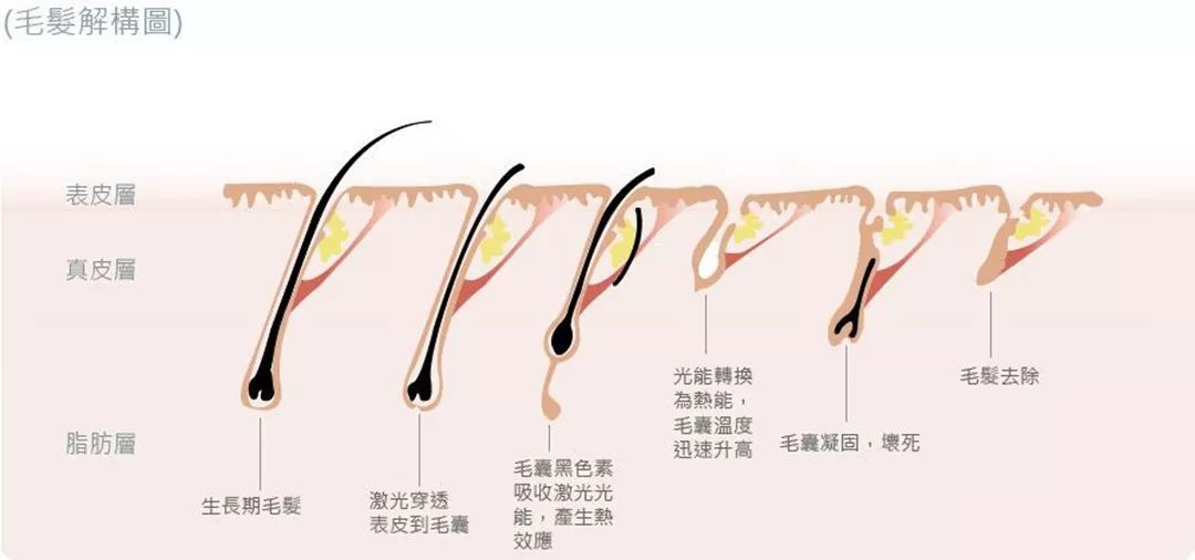 “白煮蛋”與“獼猴桃”之間，還差一個(gè)它 強(qiáng)脈沖脫毛器械，值得買嗎？