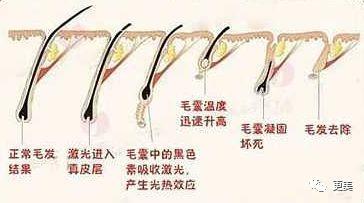 強脈沖脫毛技術(shù)與單部位色素沉著的機制解析——以劉亦菲“黑部”輿情為例